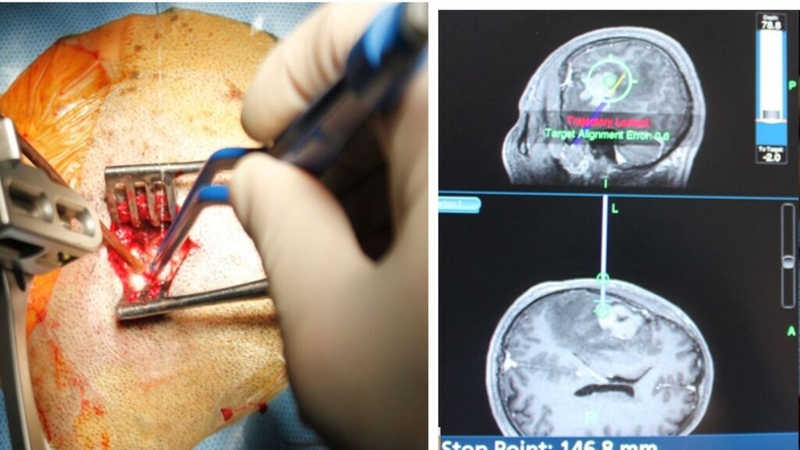 Các xét nghiệm ung thư não: Cung cấp thông tin quan trọng về chẩn đoán sớm và điều trị 4