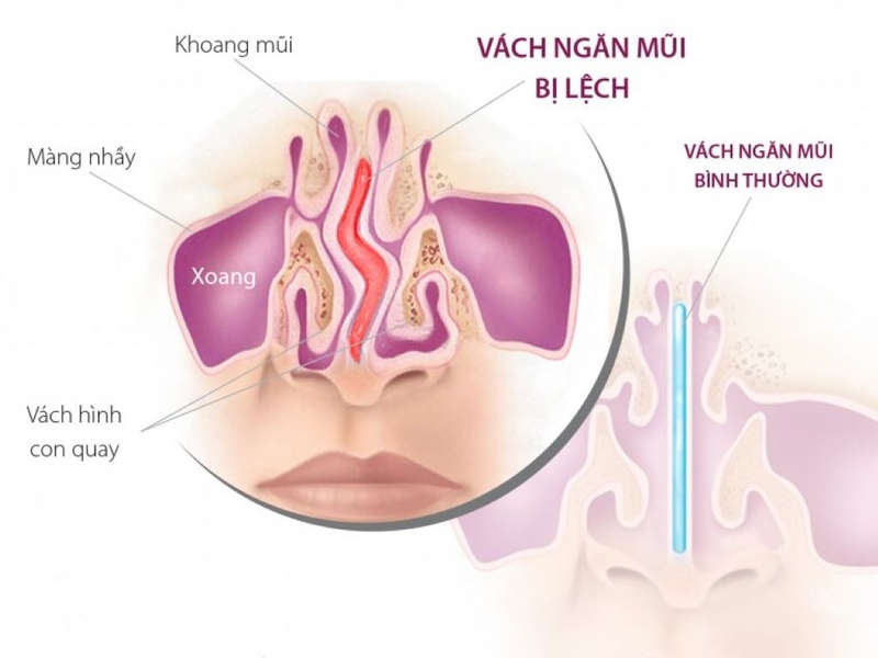 Cách bấm huyệt trị nghẹt mũi sao cho đúng và đạt hiệu quả? 1