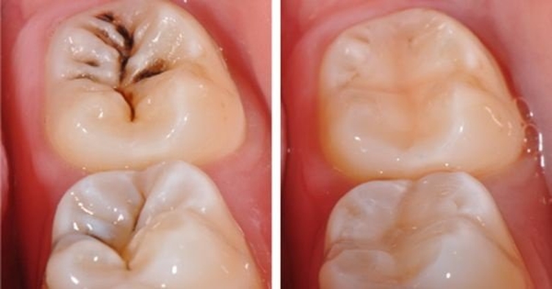 Trám răng phòng ngừa cho trẻ em