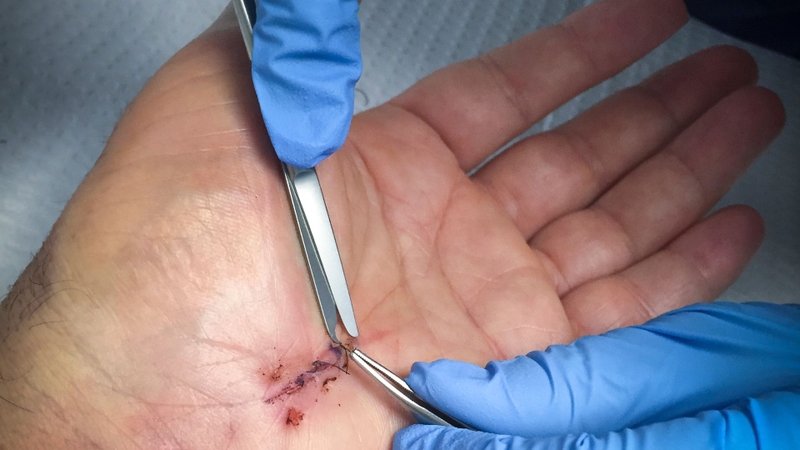 Không nên tự cắt chỉ nếu thiếu dụng cụ vô trùng