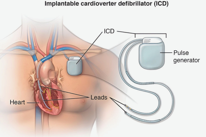 cach-cham-soc-benh-nhan-sau-dat-may-tao-nhip-tim 1.png