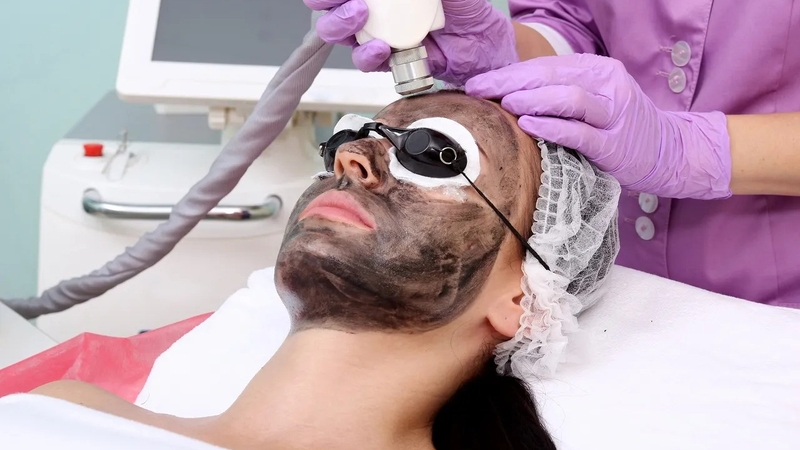 Cách chăm sóc da sau khi bắn than hoạt tính đơn giản ngay tại nhà 1