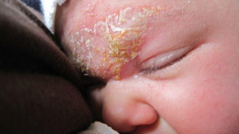 Lông mày trẻ sơ sinh có vảy là do tình trạng viêm da tiết bã 1