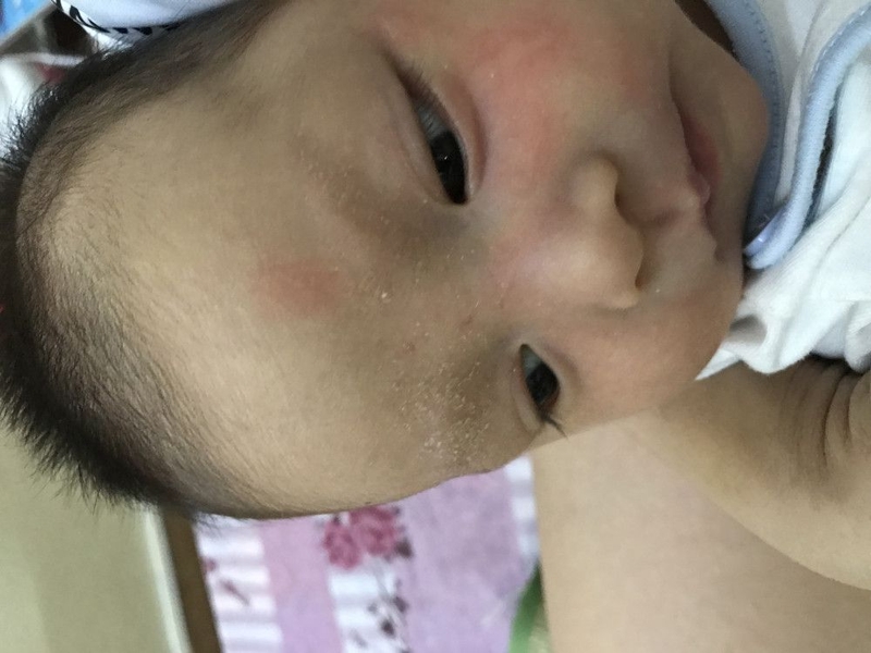 Lông mày trẻ sơ sinh có vảy là do tình trạng viêm da tiết bã 2