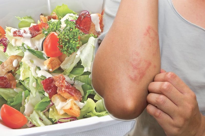 Cách chăm sóc người mắc bệnh chàm tổ đĩa 1