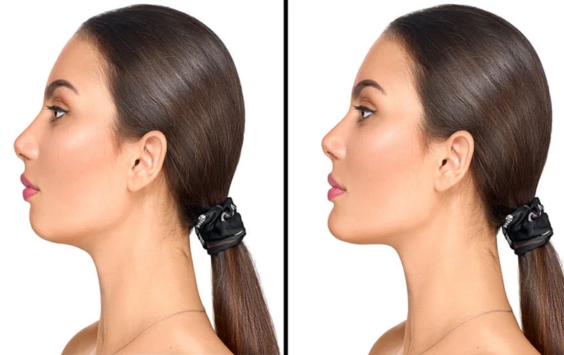 Cách chăm sóc sau khi tiêm Filler cằm để đảm bảo hiệu quả thẩm mỹ