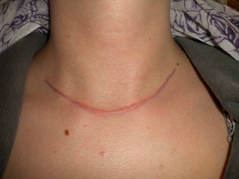 Cách chăm sóc sau mổ bướu cổ để phòng ngừa để lại sẹo 2