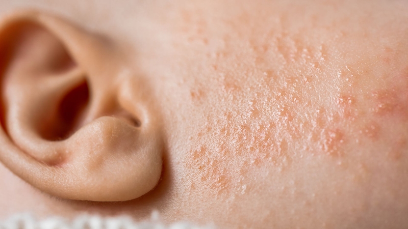 Trẻ sơ sinh bị rôm sảy ở mặt là khi da bé xuất hiện nhiều mụn nước li ti như hạt tấm, sờ vào thấy sần nhẹ