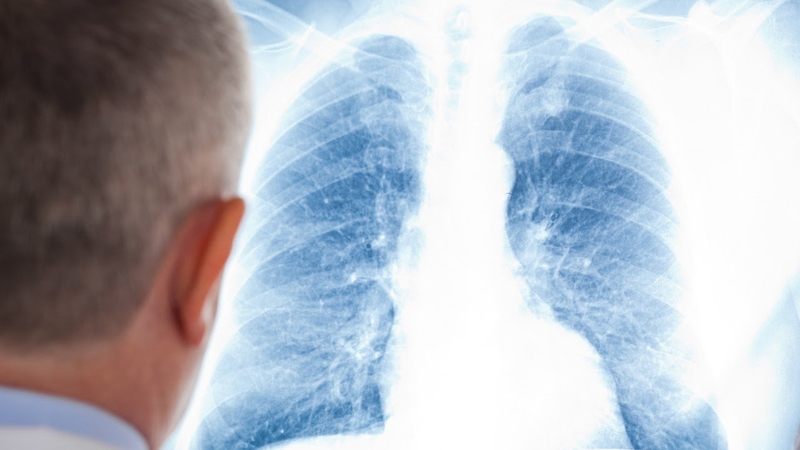 Cách chẩn đoán và điều trị giãn phế quản1