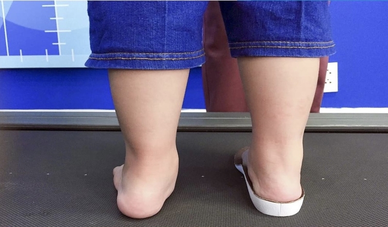 Cách chữa bàn chân bẹt ở trẻ em: Phương pháp hiệu quả và an toàn 1