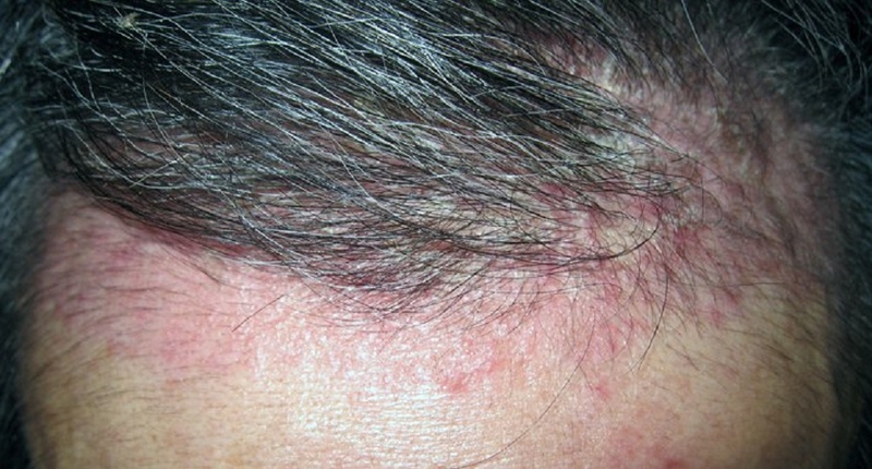 Cách chữa bệnh vảy nến da đầu tại nhà hiệu quả 1