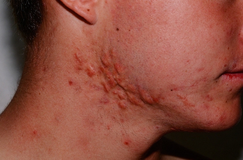 Học lỏm các cách chữa bệnh dị ứng bia rượu hiệu quả 1