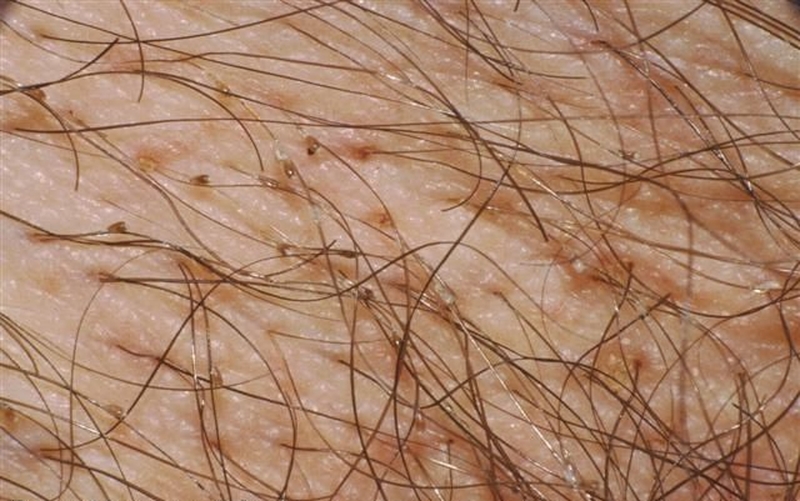 Cách chữa bệnh rận mu ở nam giới 1