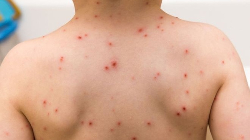 Cách chữa bệnh sởi tại nhà mà bạn nên biết - Hình 2