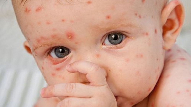 Cách chữa bệnh sởi tại nhà mà bạn nên biết-Hình 1