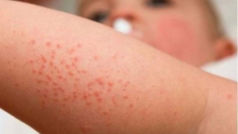 Cách chữa bệnh sởi tại nhà mà bạn nên biết - Hình 3