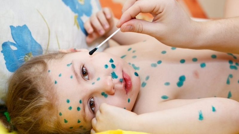 Cách chữa bệnh thủy đậu ở trẻ em, bố mẹ cần biết! 1