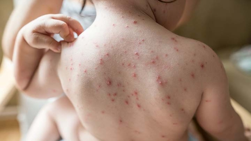 Cách chữa bệnh thủy đậu ở trẻ em, bố mẹ cần biết! 2
