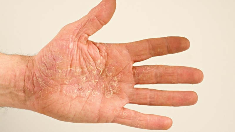 Cách chữa bệnh tổ đỉa bằng đông y hiệu quả 4