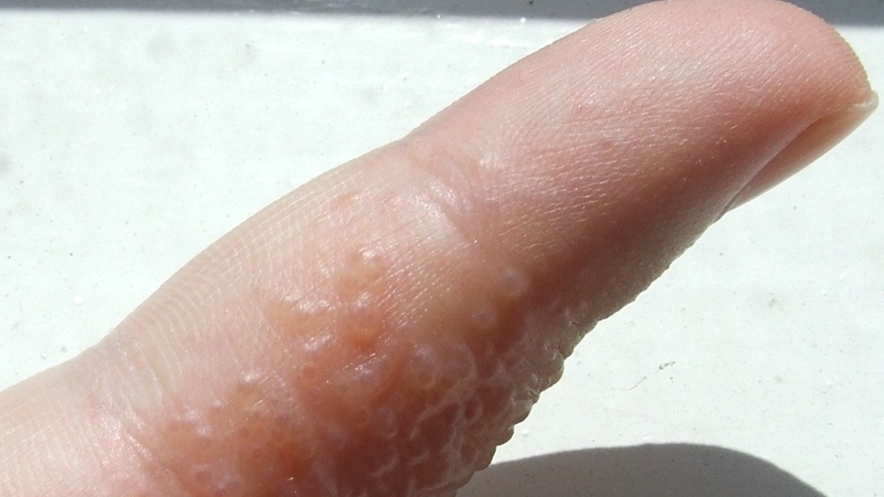 Cách chữa bệnh tổ đỉa bằng đông y hiệu quả 2