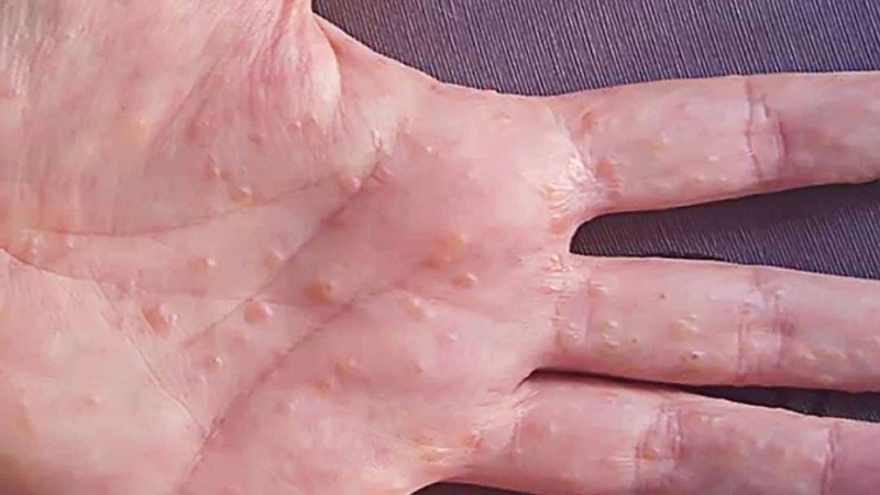 Cách chữa bệnh tổ đỉa bằng đông y hiệu quả 1