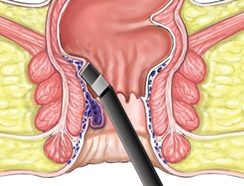 Tổng hợp toàn bộ cách chữa bệnh trĩ đang được áp dụng 3