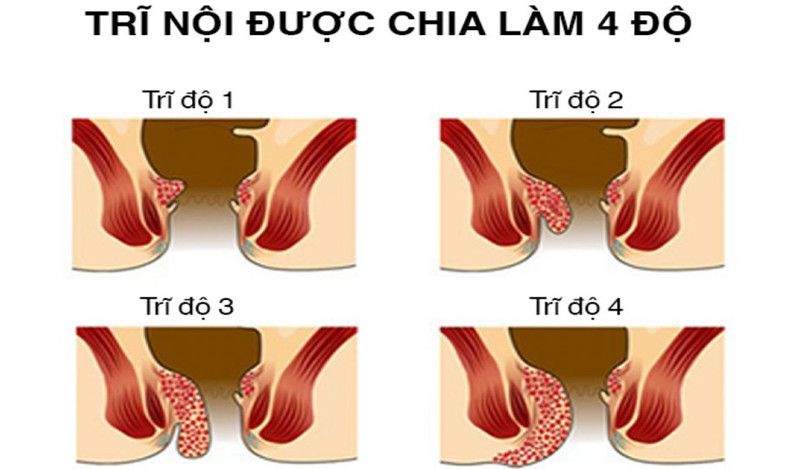 Bệnh trĩ cấp độ 4 có thể gây sưng tấy hậu môn