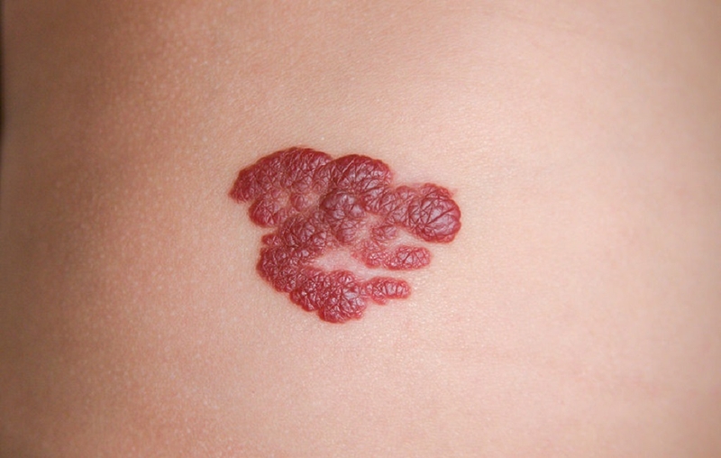 Cách chữa bệnh u máu ở người lớn mới cập nhật 1