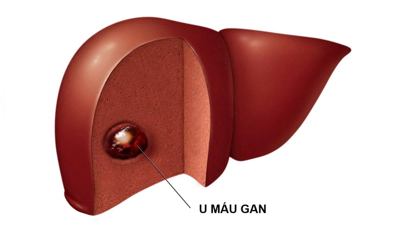 Cách chữa bệnh u máu ở người lớn mới cập nhật 2