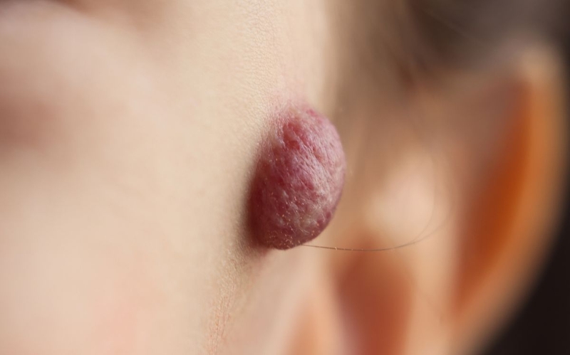 Cách chữa bệnh u máu ở người lớn mới cập nhật 3