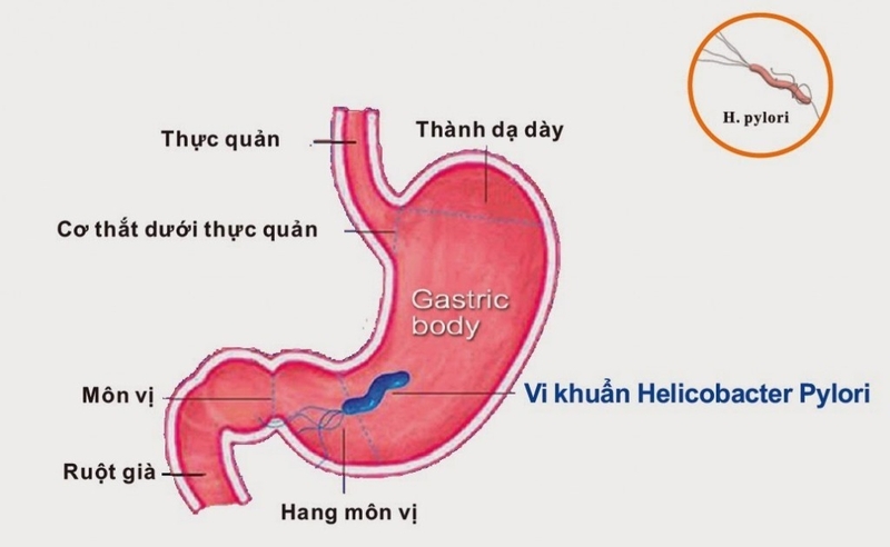 Nguyên nhân và cách chữa bệnh viêm dạ dày cấp tính 1