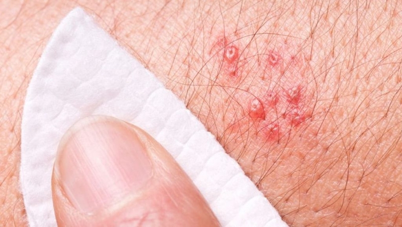 Mách bạn cách chữa bệnh zona thần kinh một cách tự nhiên 1 Mách bạn cách chữa bệnh zona thần kinh một cách tự nhiên 1