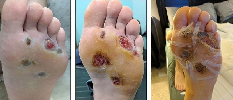 cách chữa chai chân bằng hành tím 3