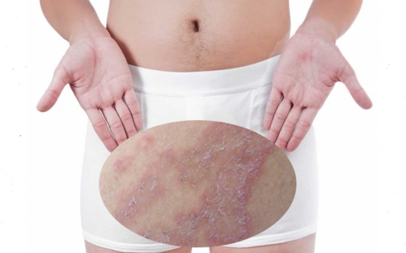 cách chữa chàm bìu tại nhà 1