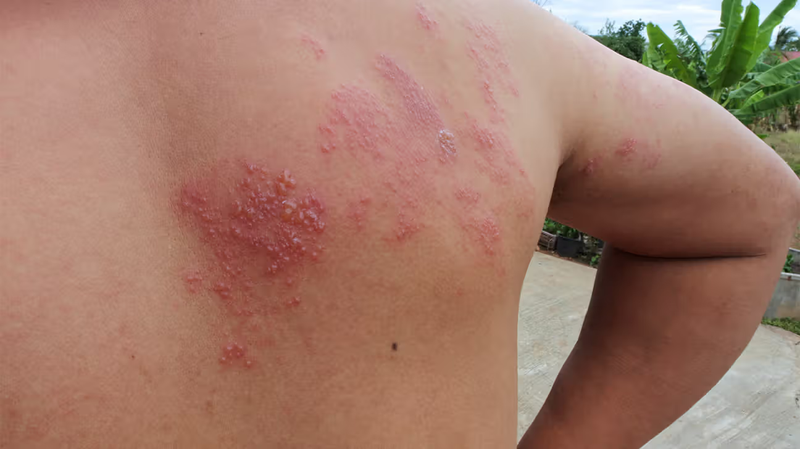 cách chữa dị ứng hải sản nhanh nhất 3