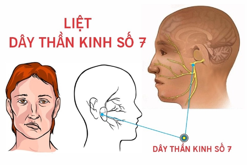 Liệt dây thần kinh số 7 ngoại biên