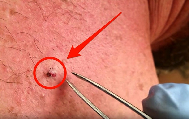 Cách chữa lông mọc ngược ở nhà đơn giản, mang lại hiệu quả cao 2