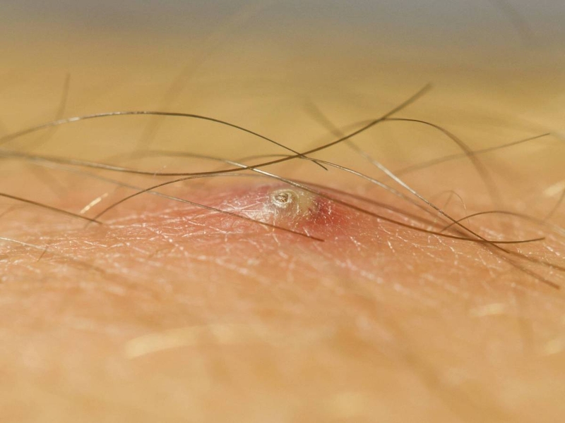 Cách chữa lông mọc ngược ở nhà đơn giản, mang lại hiệu quả cao 4