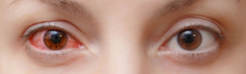 Cách chữa mắt bị đổ ghèn hiệu quả 3