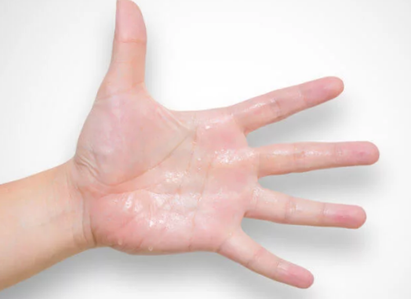 Cách chữa mồ hôi tay chân ở trẻ em mà phụ huynh cần biết 1