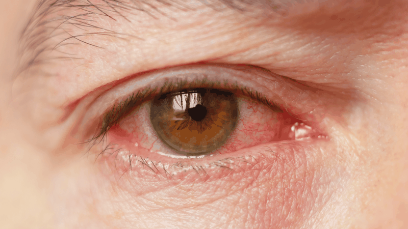 Rửa mắt bằng nước muối sinh lý là một trong những cách chữa mộng mắt tại nhà đơn giản