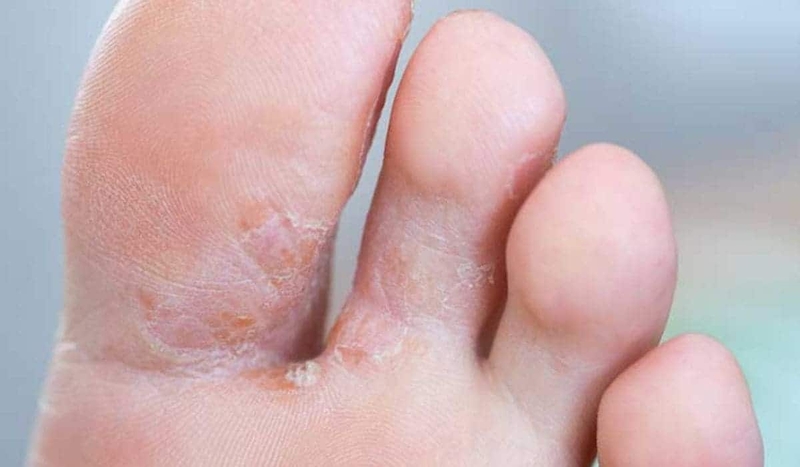 Cách chữa nấm kẽ chân hiệu quả, an toàn 1