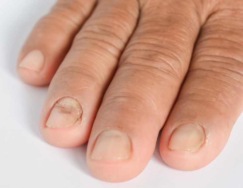 Cách chữa nấm móng tay dân gian không phải ai cũng biết 1