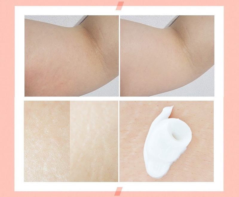 cách chữa rạn da sau sinh lâu năm 5