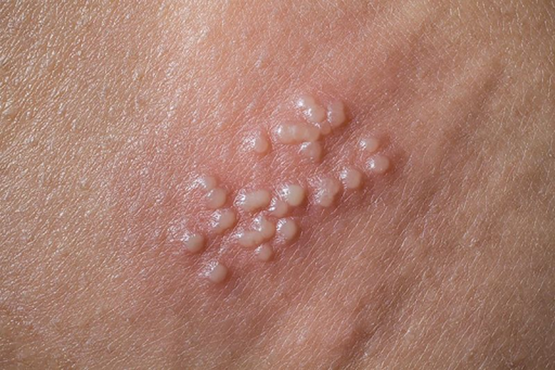 Sùi mào gà ở miệng có thể khỏi hoàn toàn nếu được điều trị kịp thời