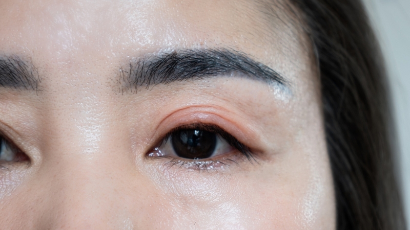 Có nhiều nguyên nhân khiến mi mắt trên bị sưng