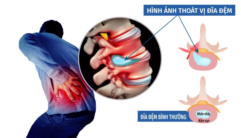 Cách chữa thoát vị đĩa đệm đốt sống cổ? Những điều bạn cần chú ý khi điều trị 1
