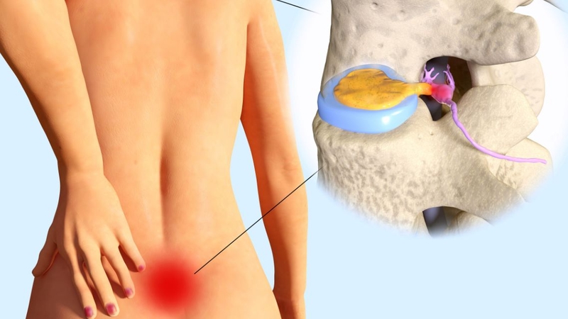 Cách chữa thoát vị đĩa đệm L4 L5 cần được lựa chọn dựa trên mức độ tổn thương