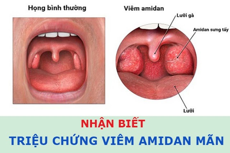 Cách chữa trị dứt điểm viêm amidan cho con hiệu quả