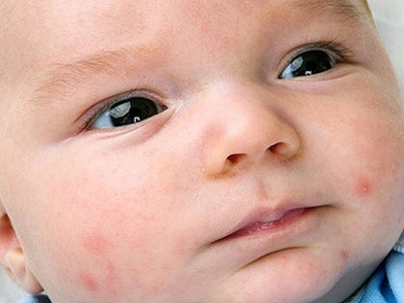 Cách chữa trị mụn nhọt ở trẻ em nhanh chóng, hiệu quả